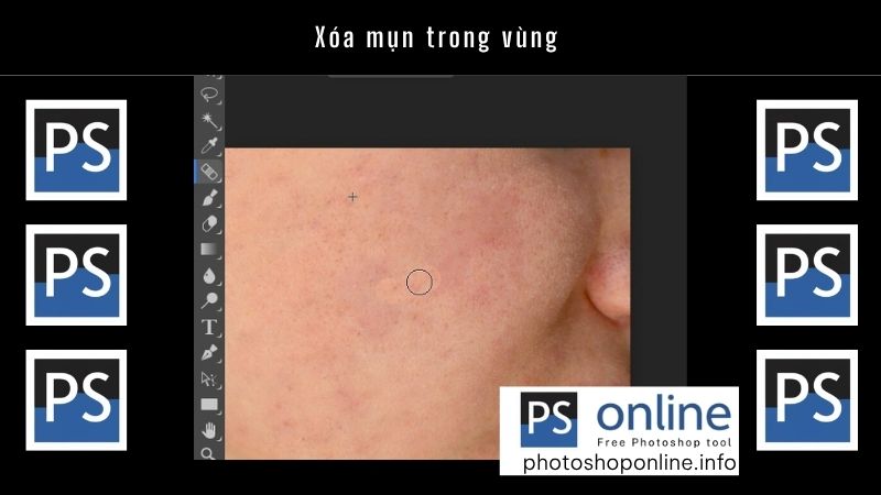Xóa mụn trong vùng
